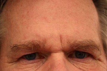 额头皮肤粗糙怎么办解决额头皮肤粗糙的方法